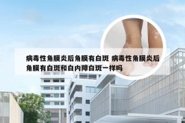 病毒性角膜炎后角膜有白斑 病毒性角膜炎后角膜有白斑和白内障白斑一样吗