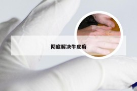 彻底解决牛皮癣