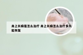 身上长癣是怎么治疗 身上长癣怎么治疗多久能恢复