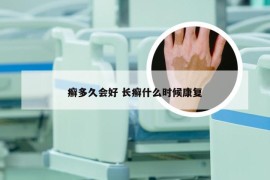 癣多久会好 长癣什么时候康复