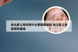 幼儿脸上有白斑什么原因造成的 幼儿脸上白色斑块是啥