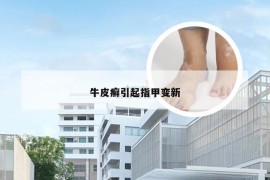 牛皮癣引起指甲变新