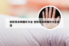 创伤性白斑图片大全 创伤性白斑图片大全高清