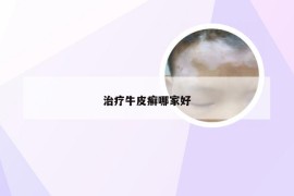 治疗牛皮癣哪家好