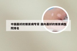 中国最好的银屑病专家 国内最好的银屑病医院排名