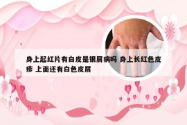 身上起红片有白皮是银屑病吗 身上长红色皮疹 上面还有白色皮屑