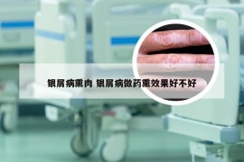 银屑病熏肉 银屑病做药熏效果好不好