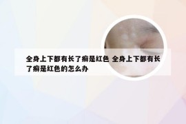 全身上下都有长了癣是红色 全身上下都有长了癣是红色的怎么办