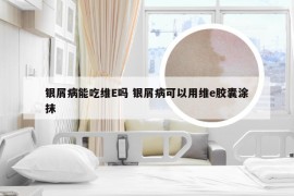 银屑病能吃维E吗 银屑病可以用维e胶囊涂抹