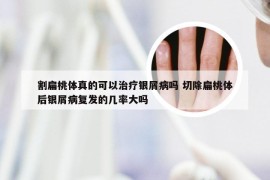割扁桃体真的可以治疗银屑病吗 切除扁桃体后银屑病复发的几率大吗