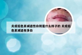 炎症后色素减退性白斑是什么样子的 炎症后色素减退有多白