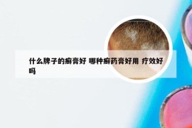 什么牌子的癣膏好 哪种癣药膏好用 疗效好吗