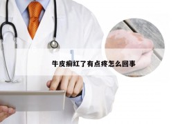 牛皮癣红了有点疼怎么回事