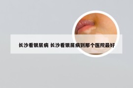 长沙看银屑病 长沙看银屑病到那个医院最好