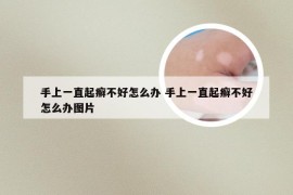 手上一直起癣不好怎么办 手上一直起癣不好怎么办图片