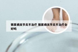 银屑病关节炎不治疗 银屑病关节炎不治疗会好吗