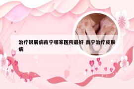 治疗银屑病南宁哪家医院最好 南宁治疗皮肤病