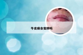 牛皮癣会变胖吗