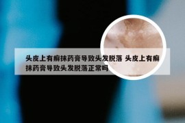 头皮上有癣抹药膏导致头发脱落 头皮上有癣抹药膏导致头发脱落正常吗