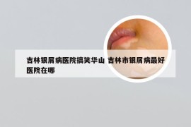 吉林银屑病医院搞笑华山 吉林市银屑病最好医院在哪