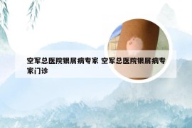 空军总医院银屑病专家 空军总医院银屑病专家门诊