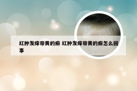红肿发痒带黄的癣 红肿发痒带黄的癣怎么回事