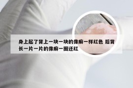 身上起了背上一块一块的像癣一样红色 后背长一片一片的像癣一圈还红