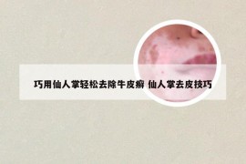 巧用仙人掌轻松去除牛皮癣 仙人掌去皮技巧
