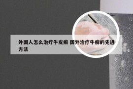 外国人怎么治疗牛皮癣 国外治疗牛癣的先进方法