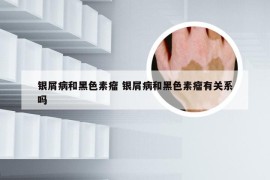 银屑病和黑色素瘤 银屑病和黑色素瘤有关系吗