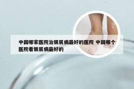 中国哪家医院治银屑病最好的医院 中国哪个医院看银屑病最好的