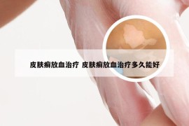 皮肤癣放血治疗 皮肤癣放血治疗多久能好