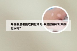 牛皮癣患者能吃枸杞子吗 牛皮肤癣可以喝枸杞水吗?