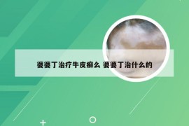 婆婆丁治疗牛皮癣么 婆婆丁治什么的