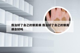我治好了自己的银屑病 我治好了自己的银屑病会好吗