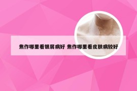 焦作哪里看银屑病好 焦作哪里看皮肤病较好