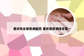 重庆知名银屑病医院 重庆银屑病排名第一