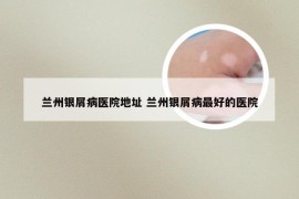兰州银屑病医院地址 兰州银屑病最好的医院