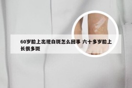 60岁脸上出现白斑怎么回事 六十多岁脸上长很多斑