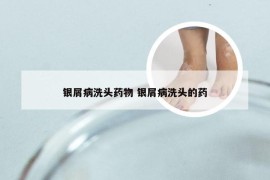 银屑病洗头药物 银屑病洗头的药