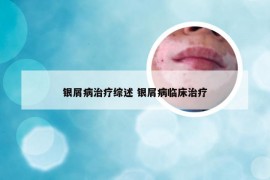 银屑病治疗综述 银屑病临床治疗