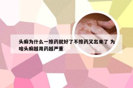 头癣为什么一擦药就好了不擦药又出来了 为啥头癣越用药越严重