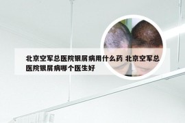 北京空军总医院银屑病用什么药 北京空军总医院银屑病哪个医生好