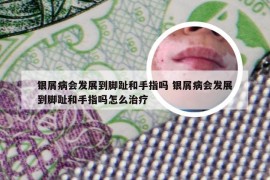 银屑病会发展到脚趾和手指吗 银屑病会发展到脚趾和手指吗怎么治疗