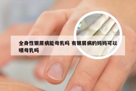 全身性银屑病能母乳吗 有银屑病的妈妈可以喂母乳吗