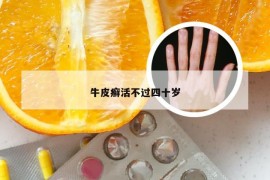 牛皮癣活不过四十岁