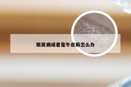 银屑病或者是牛皮癣怎么办