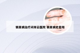 银屑病治疗问祥云医院 银屑病史星翔