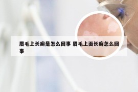 眉毛上长癣是怎么回事 眉毛上面长癣怎么回事