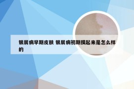 银屑病早期皮肤 银屑病初期摸起来是怎么样的
